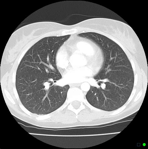 Chest CT Scan .